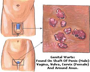 Genital Warts Picture