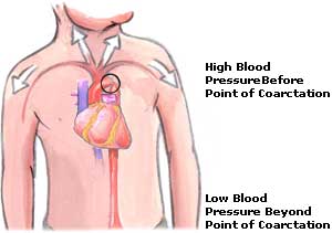 Low Blood Pressure  Picture