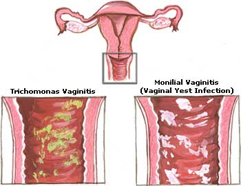 Yeast Infection Picture