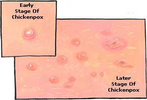 Chickenpox Stages Pictures