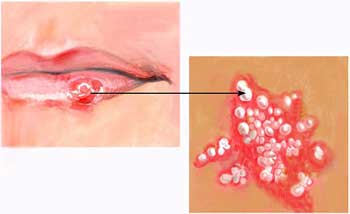 Lip Herpes Zoster Treatment : Herpes - Treating The Pain
