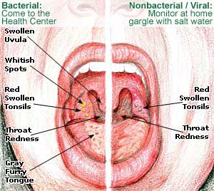 tonsil scars