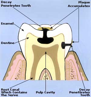 Toothache Symptoms