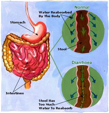 dehydration and overflow diarrhea