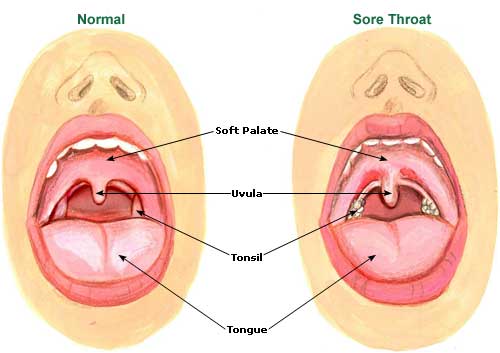How To Get Rid Of A Swollen Throat